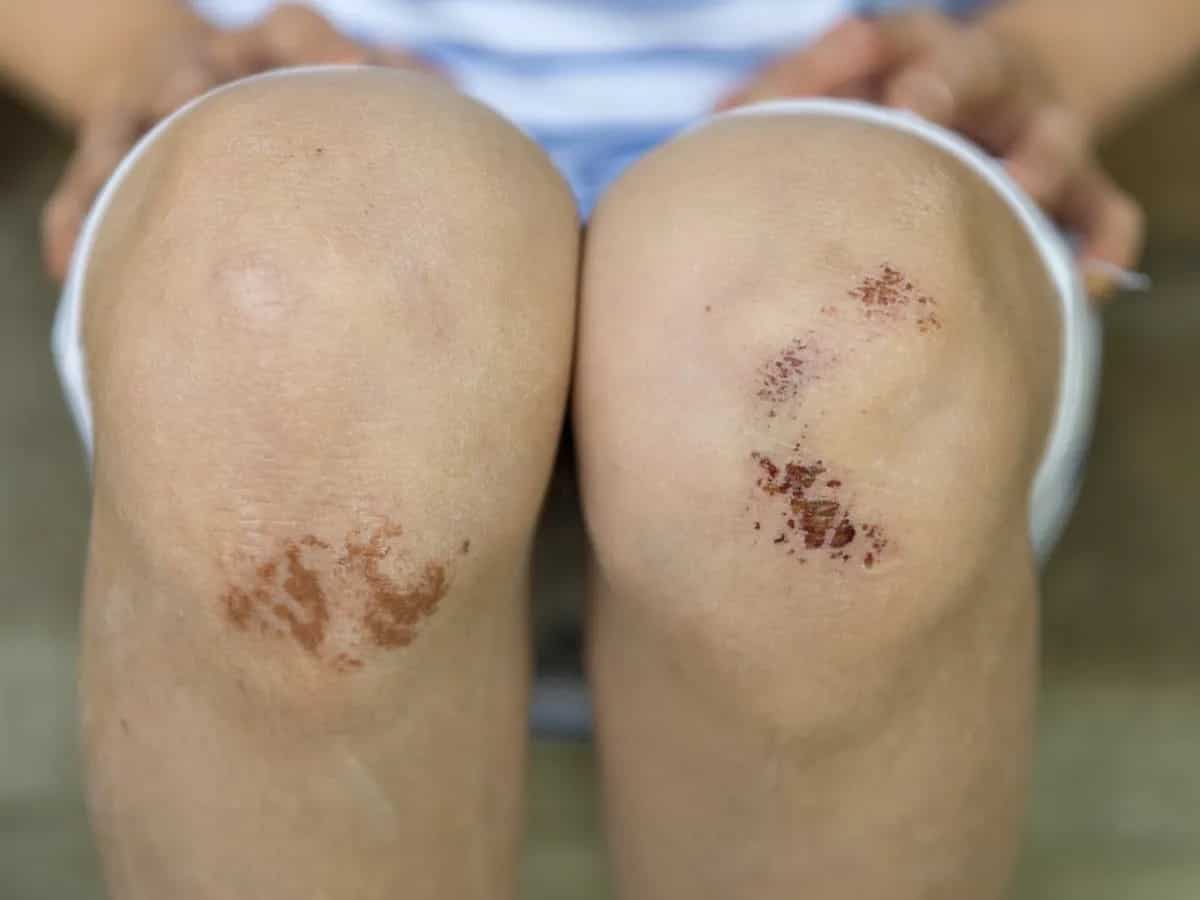 Try These 7 Ayurvedic Remedies To Heal A Wound