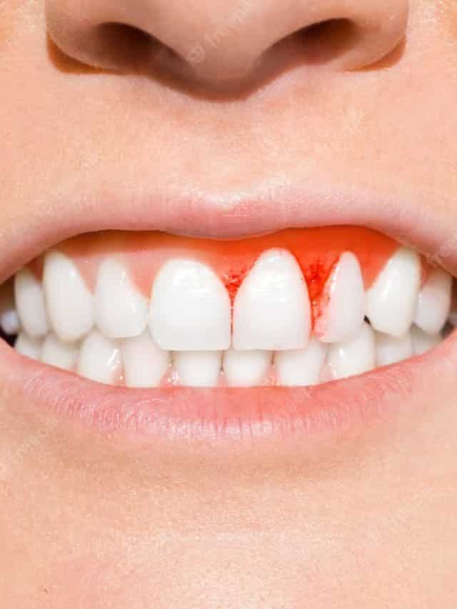5 Vitamin And MineralRich Foods To Reduce Bleeding Gums